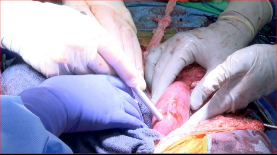 Un ri&ntilde;&oacute;n de cerdo funciona en una persona desde hace m&aacute;s de un mes en EEUU