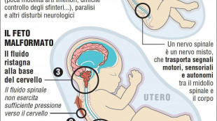 Spina bifida, sei interventi in utero con le staminali
